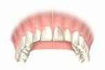 diagram of dental crowns and bridges
