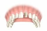 dental crown picture