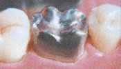 silver crown on a tooth