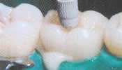 dental crown restoration process
