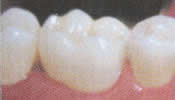 final image of CEREC crown on a tooth