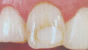 discolored tooth