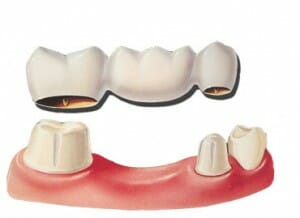 fixed dental bridge on top of teeth