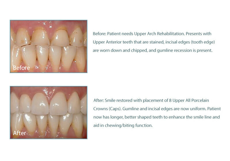 before and after picture of Fixari Family Dental patient with porcelain crowns