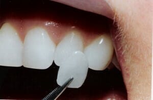 dental veneer next to a natural tooth