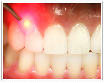 cavity detection in Columbus Ohio