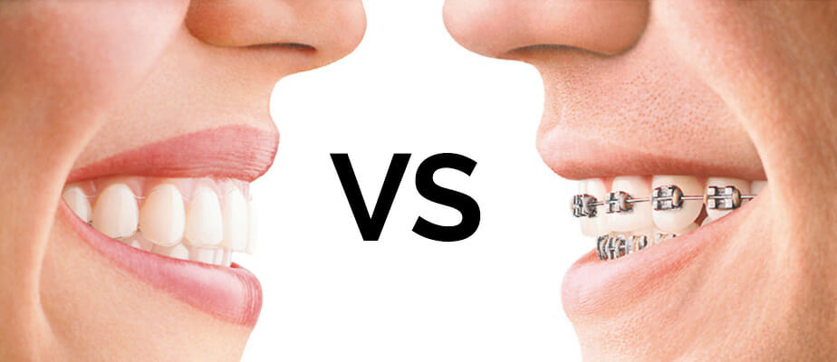 Invisalign vs Braces – We reveal the truth about how they compare - The  Dental Room