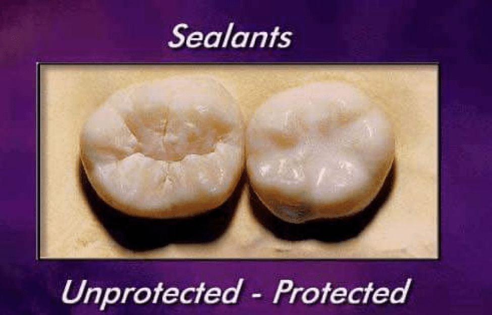 dental sealants