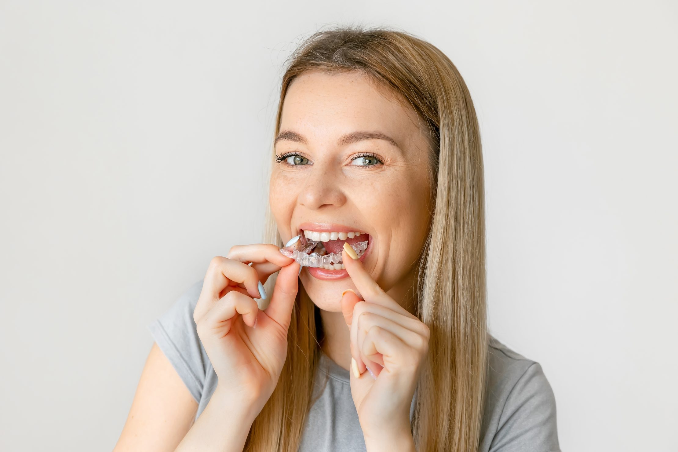 Clear Aligners for Adults: Why Spring Is a Popular Time to Start Treatment